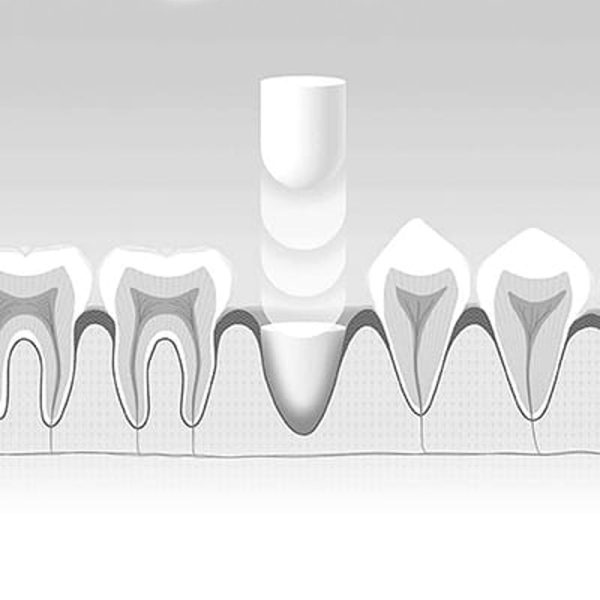 Collagen-Based Bone Filling Foundation Material For Cheap